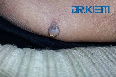Skin tags 01